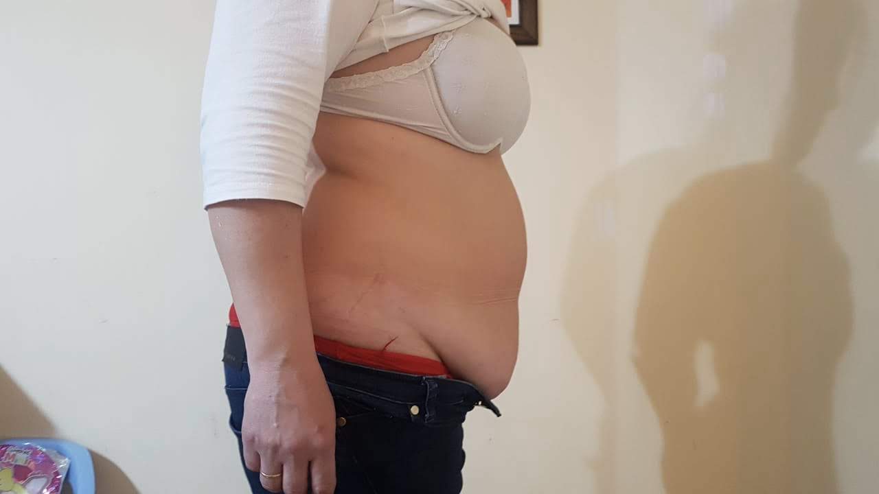 Resultado de abdomen antes y después