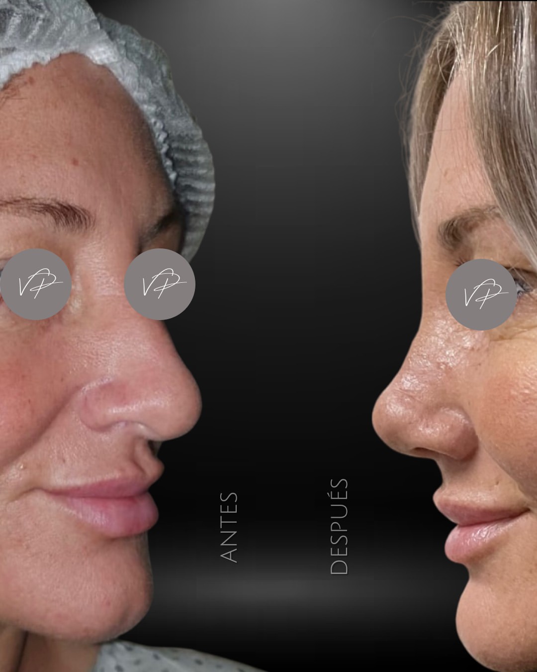 Resultado de rinoplastia antes y después