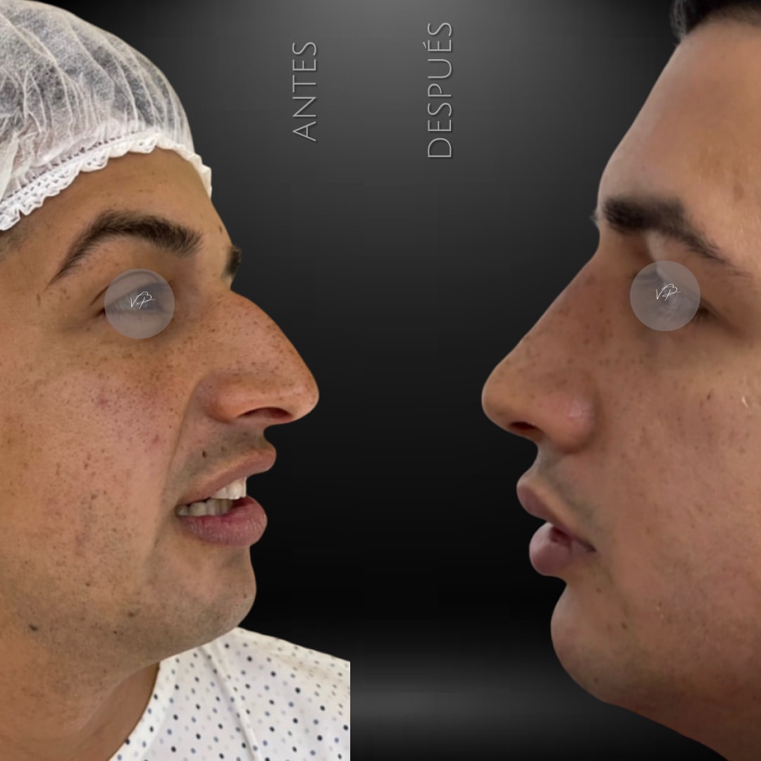 Resultado de rinoplastia antes y después